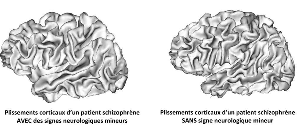 Schizophrénie Les Plis Du Cerveau Pourraient Ils être Des - 