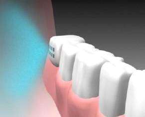 Implant dentaire IntelliDrug