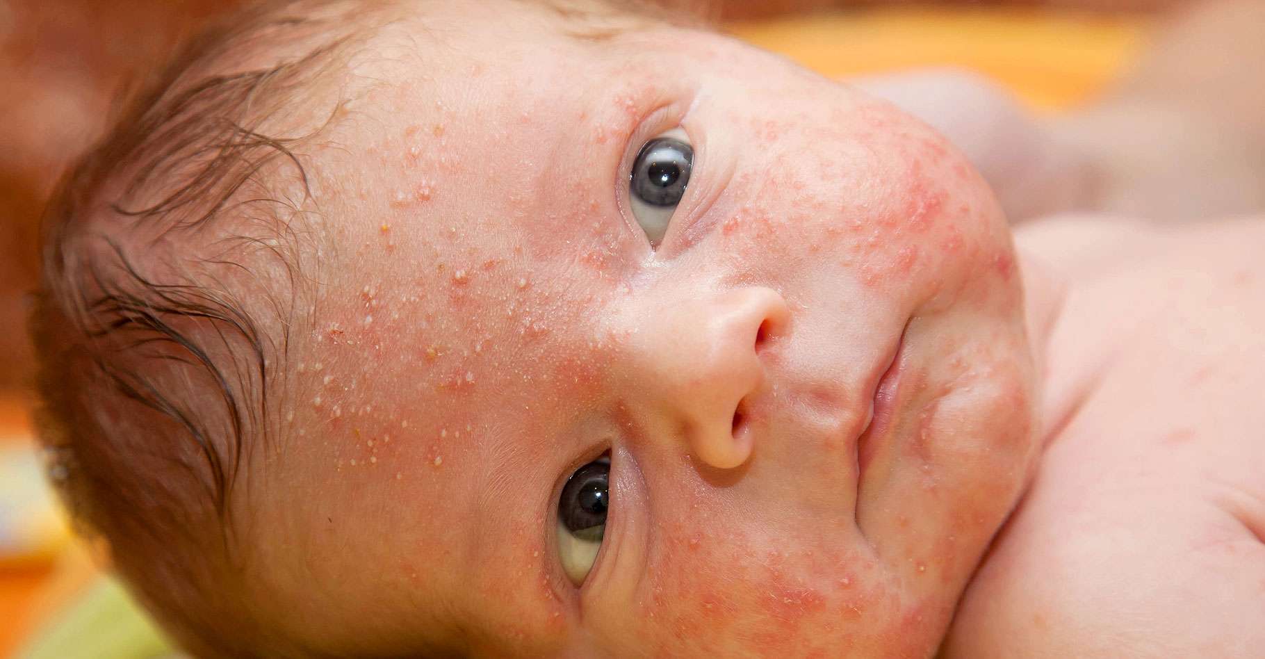 Boutons de bébé : l'acné du nourrisson | Dossier