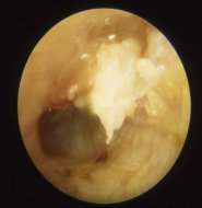 Le choléstéatome est marqué par le présence de squames épidermiques (zone blanchâtre). © DR