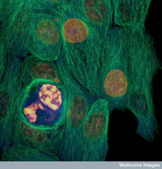 Le cancer du sein, dont on voit des cellules tumorales à l'image, est le plus fréquent et le plus meurtrier chez la femme. En France, 53.000 nouveaux cas ont été détectés (33 % de l'ensemble des cancers) en 2011, et 11.500 personnes en sont mortes (18 % de la mortalité). © David Becker, Wellcome Images, Flickr, cc by nc nd 2.0