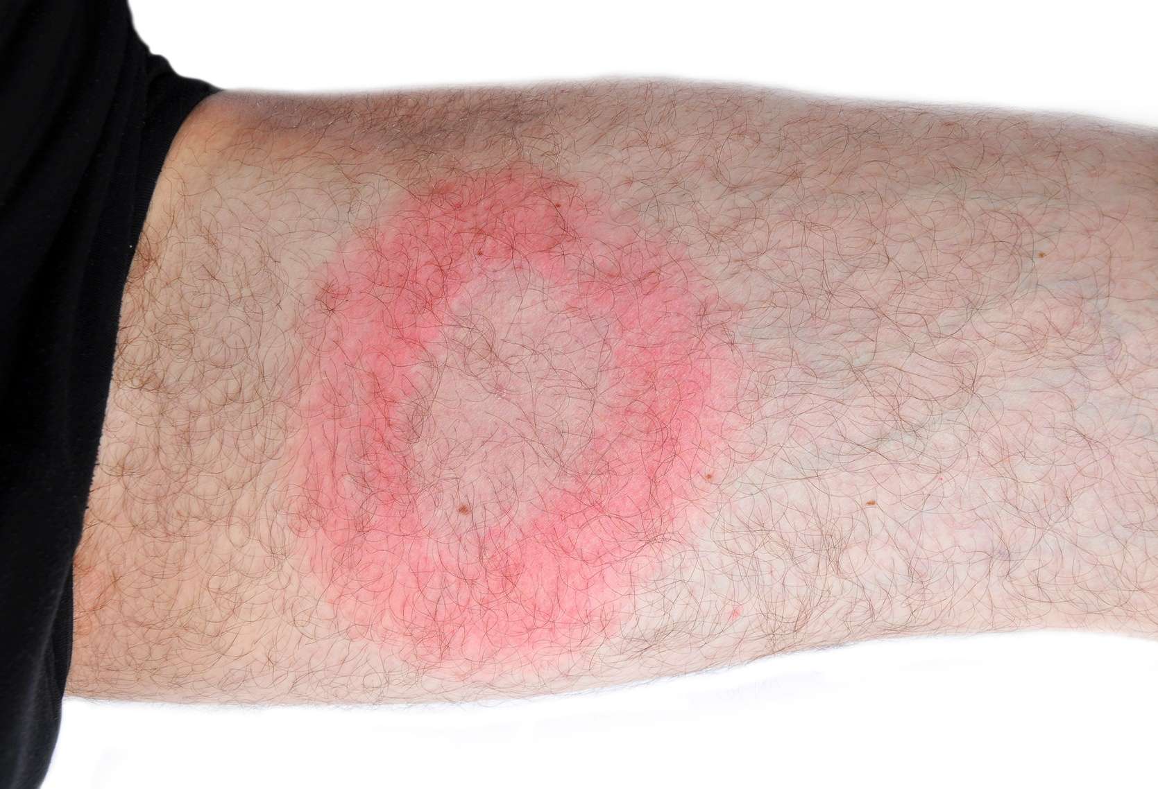Borr liose De Lyme Alsace Borrelia Traitement LZBN Borr liose De Lyme Alsace Borrelia Traitement LZBN