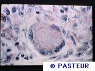 Augmentation des cas de lèpres aux Etats-Unis Crédits : Institut pasteurLEPRE MURINE DUE A MYCOBACTERIUM LEPRAEMURIUM (BACILLE DE STEFANSKY)FORMATION DE CELLULES GEANTES