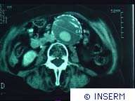Diagnostic rapide des hémorragies cérébrales SCANNER ABDOMINAL : ANEVRYSME DE L'AORTE AVEC CAILLOT ENDOLUMINAL.Crédits : INSERM