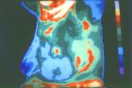 Nouvelle avancée dans la compréhension du cancer du sein Crédits : INSERM 90Dépistage du cancer du sein