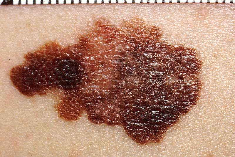 Les mélanomes forment des taches noires sur la peau. Wikimedia Commons