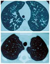 En bas, image scanner d’un poumon normal. En haut, les bronches sont envahies par un mucus épais. C’est la mucoviscidose. © Serv