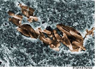 L'ulcère de Buruli est provoqué par la bactérie Mycobacterium ulcerans. © Institut Pasteur