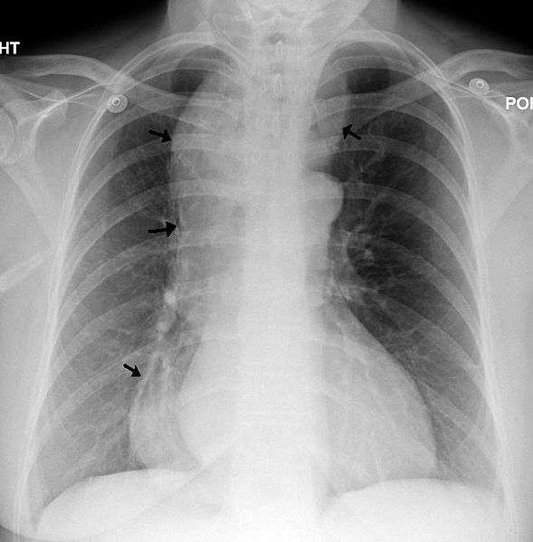 Définition | Achalasie - Méga-œsophage - Cardio-spasme