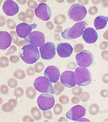 Les cancers hématopoïétiques sont une grande famille de cancers, regroupant notamment les leucémies. Cette image montre des cellules précurseurs des lymphocytes B chez une personne atteinte de leucémie lymphoblastique aiguë. © VashiDonsk, Wikipédia, cc by sa 3.0