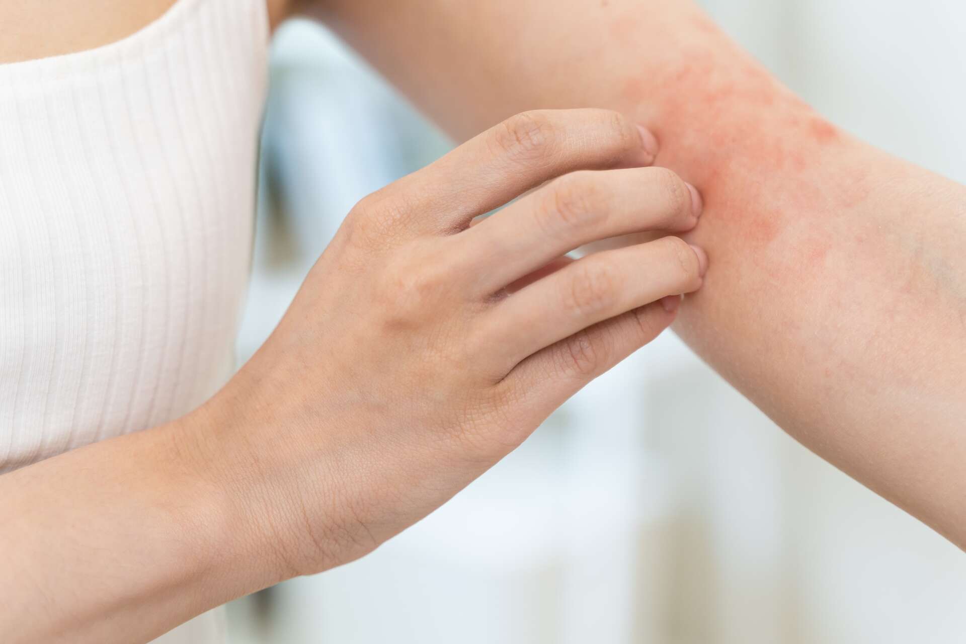 Comment reconnaître une réaction allergique cutanée