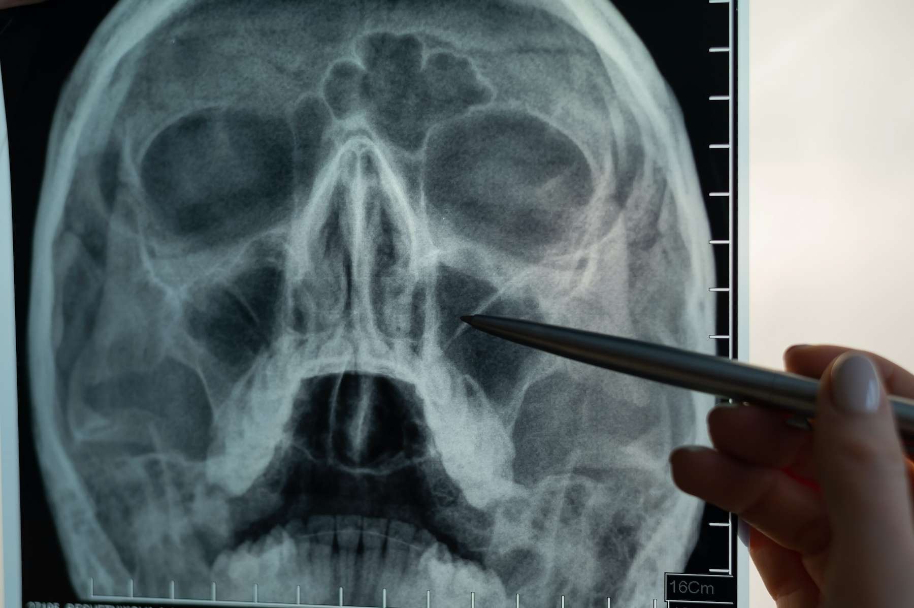 Patient bizarre une odeur fétide révèle une balle coincée dans son nez depuis huit ans