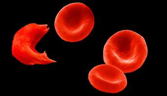 Trois hématies (ou globules rouges) normales, à droite et une hématie drépanocytaire, à gauche, très déformée et plus rigide. En cause : l'hémoglobine de type S qu'elle contient peut se polymériser en l'absence d'oxygène. © NHS