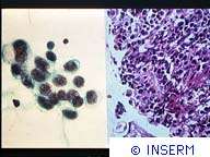 Un logiciel pour dépister les cancers de la prostate Histologie du cancer du poumon à l'aide d'une coloration standard utilisée en anatomo-pathologie. La partie droite de la diapositive montre un tissu cancéreux avec de gros noyaux cellulaires, en noir. Crédits : INSERM