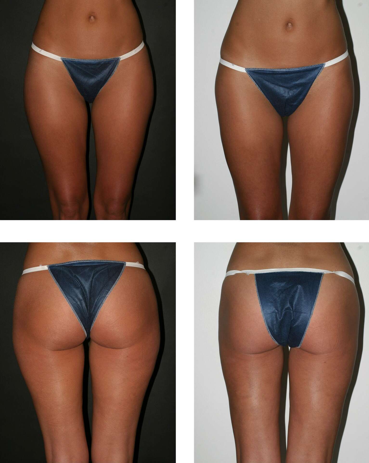 D finition Liposuccion Lipoaspiration d-finition-liposuccion-lipoaspiration