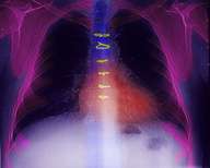 L'aspirine, garantie importante de succès d'un pontage Crédits : INSERM ALPHA PICT 2000Radiographie du thorax après pontage coronaire. On distingue les fils de suture en acier au niveau du sternum.