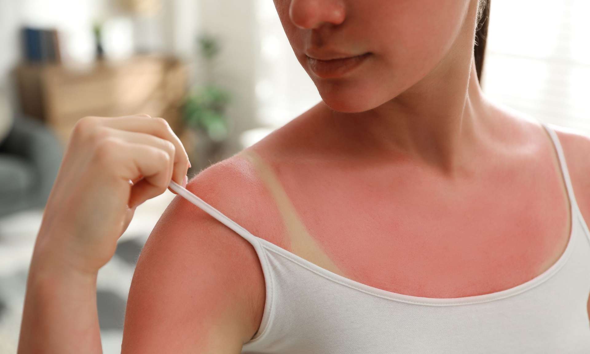 C'est quoi cette nouvelle tendance « Burn lines » qui consiste à se brûler la peau au soleil ?