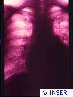 Maladies cardiaques : mythe ou réalité des différences ethniques ? Crédits : INSERM 89.COEUR EN INSUFFISANCE CARDIAQUE. VUE DE LA CAGE THORACIQUE.