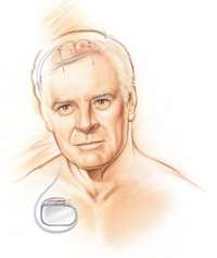 Le cerveau en vedette du 10 au 16 mars Schéma d'un dispositif de stimulation cérébrale profonde (modèle Activa, de marque Medtronic), avec le stimulateur et les deux électrodes dans le cerveau. © Medtronic