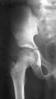 Comment cultiver du tissu osseux pour réaliser des greffes in vivo Crédits : CORDIS