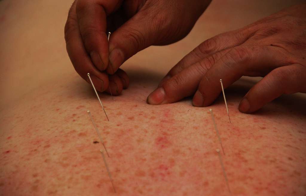 L'acupuncture nous vient de la médecine traditionnelle chinoise. Elle consiste à placer des aiguilles à des endroits très précis du corps. Cette technique pourrait aider à lutter contre la dépression... © Renato Ganoza, Flickr, cc by 2.0