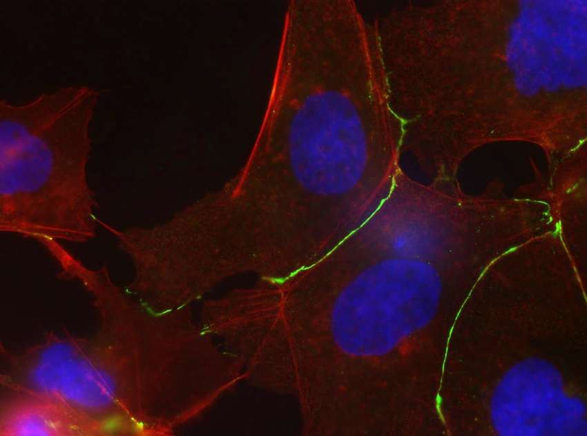 Ces cellules de lignée Hep3B sont issues d'un patient avec un cancer du foie, et déficientes en un gène : Hnf1a. En rouge on peut voir apparaître la N-cadhérine, en vert la phalloïdine et les noyaux sont bleus. © Jessica Zucman-Rossi, Inserm