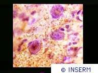 Crédits : INSERM 90.Parkinson. Greffes de neurones thalamiques, marquage immunocytochimique des fibres contenant du gaba.