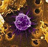 Irradiation : une greffe de cellules souches pour éviter l'amputation Cellule souche dans la moelle osseuse(Crédits : www.rds-online.org.uk)