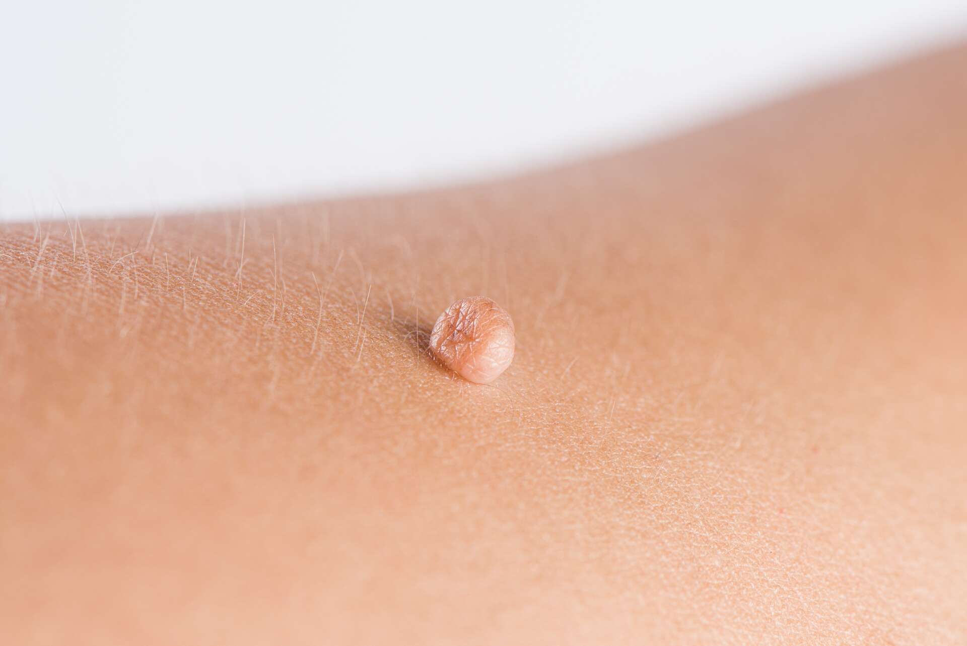 Acrochordon : quel traitement naturel pour s'en débarrasser