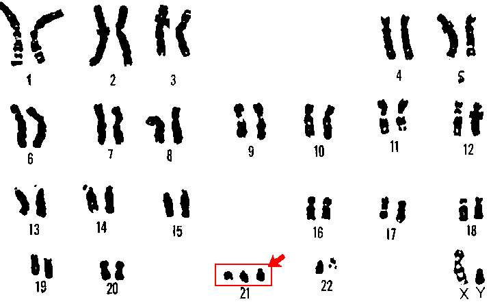 Le caryotype d'un trisomique 21 présente souvent 47 chromosomes (3 chromosomes 21), mais parfois 46 dans le cas de trisomie par translocation. © DR