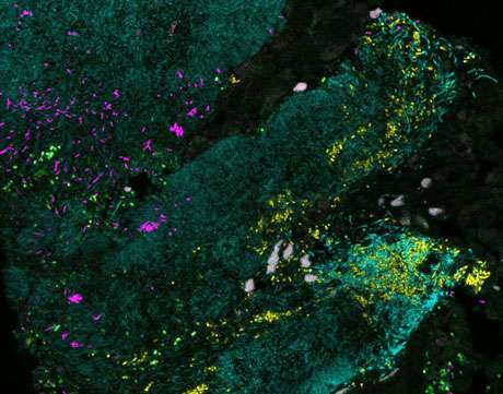 On voit bien sur ce cliché obtenu en imagerie par fluorescence combinatoire les différentes espèces de bactéries formant un biofilm sur un tissu cancéreux du côlon. © Jessica Mark Welch, Blair Rossetti, & Christine Dejea