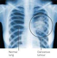 Cancer du rein : des pilules porteuses d'espoir Le Sutent permet-il de retarder la croissance du cancer du poumon ?(Crédits : DogFlu.Ca)