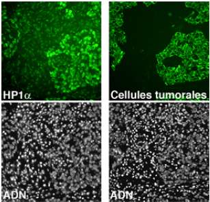 Quatre images de cellules tumorales au sein d'un tissu normal. En haut, deux colorants, verts tous les deux, marquent, à gauche, la protéine H1 alpha et, à droite, les cellules tumorales. On remarque que les formes colorées coïncident : la protéine HP1 alpha est présente en plus grande quantité dans les tumeurs. Les deux images du bas visualisent l'expression du gène (ADN) conduisant à la fabrication de la protéine HP1 alpha. Là aussi, on note qu'elle est plus forte dans les cellules tumorales. © Noak/Le Bar/Floréal-Leanne de Koning-C. Charré/Institut Curie