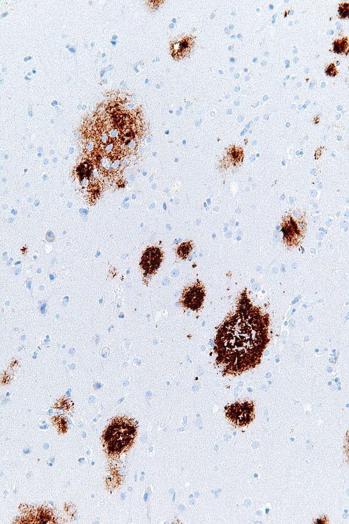 La maladie d'Alzheimer se caractérise notamment par un agrégat de bêta-amyloïde formant des plaques séniles au niveau des neurones, comme on peut les voir à l'image. Les dernières thérapies visent à essayer de les dissoudre. © Nephron, Wikipédia, cc by sa 3.0