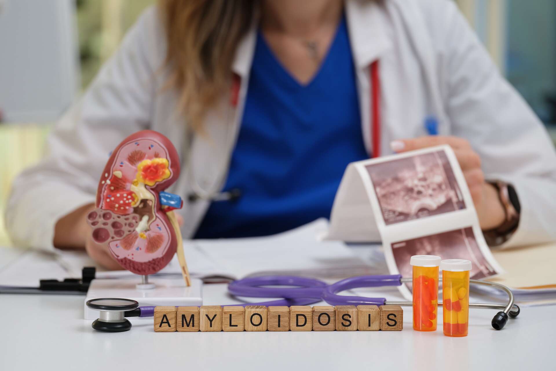 L’ARN interférent (ARNi) : une avancée thérapeutique majeure contre l’amylose à transthyrétine (ATTR)