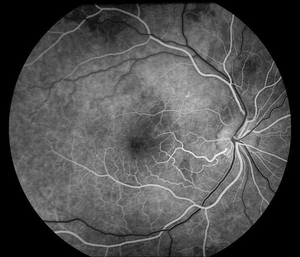 Definition Angiographie Retinienne Futura Sante