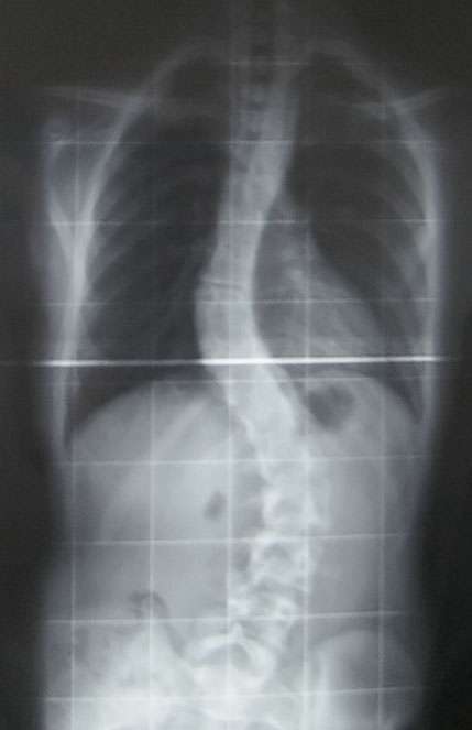La scoliose lombaire donne un aspect en S à la colonne vertébrale, visible sur une radiographie. © Dr Junge, Wikipedia, DP