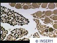 L'amyotrophie spinale sur le devant de la scène Crédits : INSERM.AMYOTROPHIE SPINALE INFANTILE. MUSCLE HUMAIN.