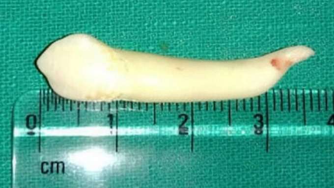 Un Indien de 20 ans s’est vu retirer une dent de 3,9 cm, la dent la plus longue du monde. © IntEngineering, Twitter