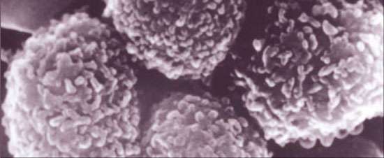 La leucémie est un cancer des cellules de la moelle osseuse vouées à rejoindre la circulation sanguine une fois arrivée à maturation. La leucémie aiguë lymphoblastique concerne très majoritairement une multiplication anormale de lymphocytes B ou précurseurs inactifs qui, en l'absence de traitements, vont s'accumuler dans l'organisme. La reprogrammation génique des lymphocytes T à partir du VIH pourrait en venir à bout. © DR