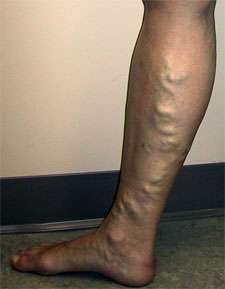 les varices dans les jambes