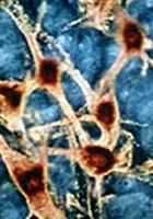 Des neurones sur mesure contre la maladie de Parkinson On sait désormais forcer la différenciation d'une cellule souche en un neurone présentant certaines caractéristiques.