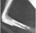 Un implant qui diffuse des antibiotiques dans le corps Fracture de l'avant bras