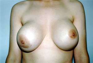 Contracture capsulaire du sein droit, sept ans après la pose d'un implant mammaire en silicone. © Walter Peters, Wikimedia Commons, domaine public