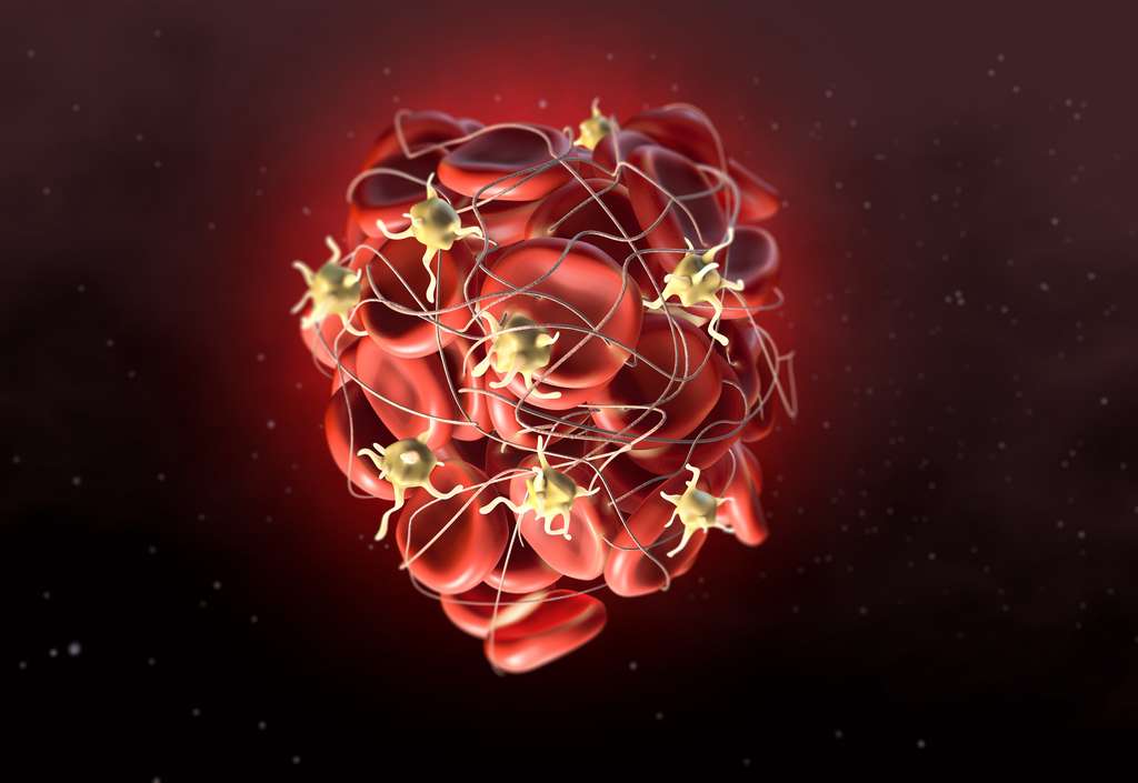 Un thrombus est un caillot composé de globules rouges, de plaquettes et de fibrines. Ils provoquent des thromboses. © Axel Kock, Adobe Stock