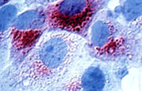 Étude de marqueurs tumoraux dans le pronostic du cancer du sein. Marquage immunohistochimique de la Cathepsine D hyperexprimée dans des cellules de lignée humaine de carcinomes mammaires MCF 7 (Métastase cellulaire facteur 7). La Cathepsine D est une enzyme lysosomiale acide qui favoriserait le potentiel métastatique des cellules tumorales. © H. Rochefort/Inserm - Reproduction et utilisation interdites