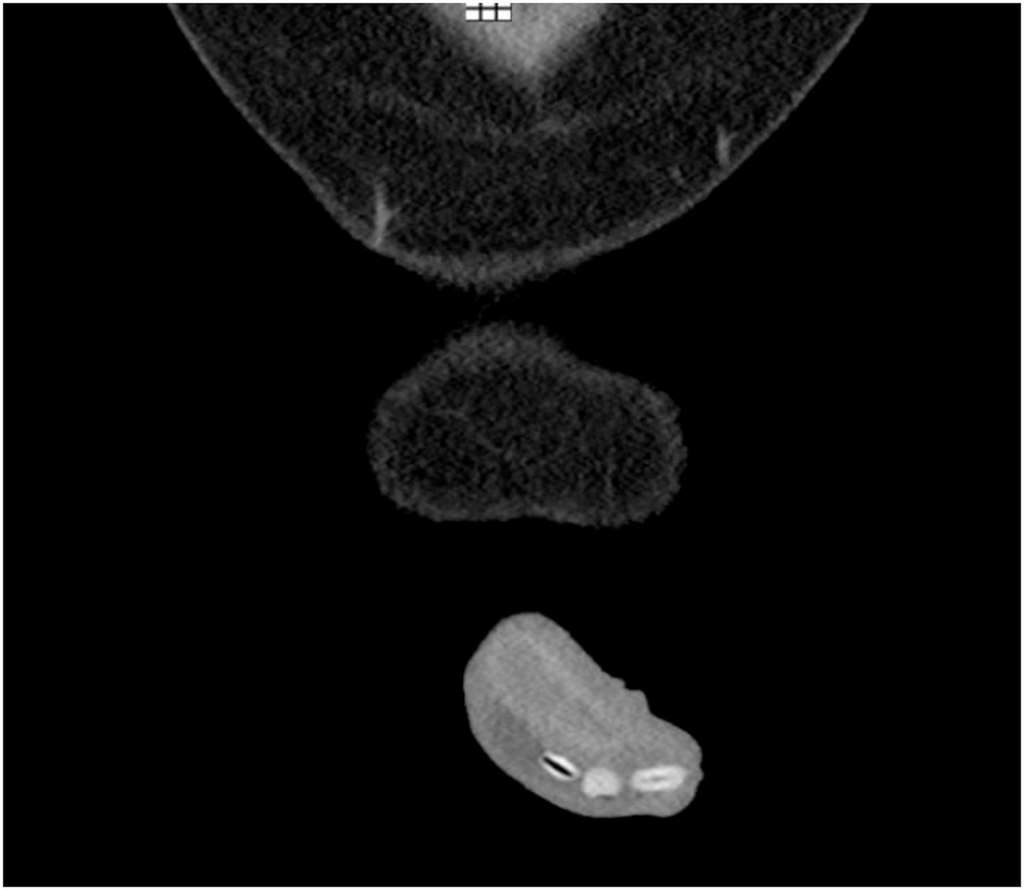 L’image du scanner montre la présence de trois haricots dans l’urètre distal du pénis. © Margeaux Dennis et al, Urology Case Reports, 2021