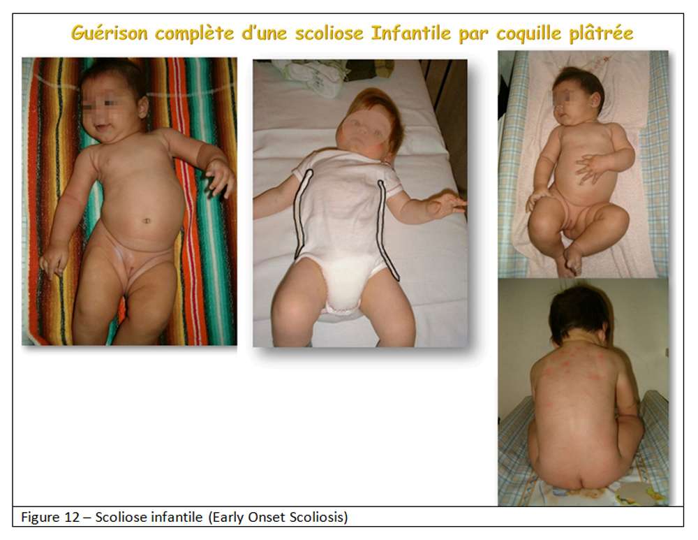 Scoliose Les Signes Cliniques Chez L Enfant Dossier Scoliose Les Signes Cliniques Chez L Enfant Dossier