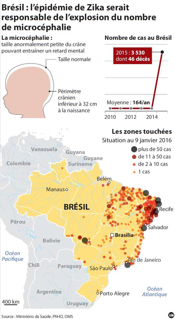 Au Brésil, alors que la microcéphalie touchait jusque-là 164 enfants par an en moyenne, le nombre de cas a grimpé à 3.530 en 2015. © Idé