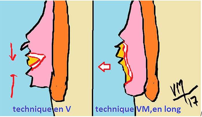 Techniques en V et VM en long. © Dr Mitz, tous droits réservés